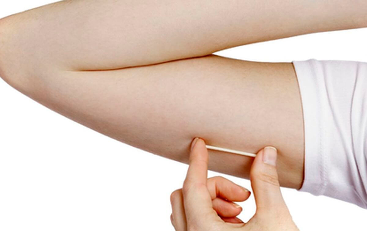 implanon anticonceptivo del brazo Medellín